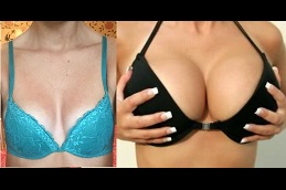 Best silicBest silicone-breast-implant Clinic in Dubaione-breast-implant Clinic in Dubai
