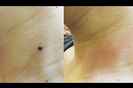 Best skin-lesion-removal-cost Clinic in Dubai