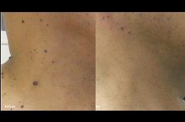 Best skin-lesion-removal-cost in Abu Dhabi