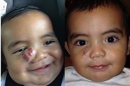 Best strawberry-hemangioma-treatment-for-baby Clinic in Dubai