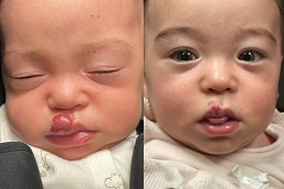 Best strawberry-hemangioma-treatment-for-baby in Abu Dhabi