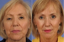 Blepharoplasty Surgeon in Dubai & Abu Dhabi