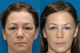 Blepharoplasty Surgeon in Dubai