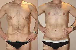 Body Lift – Belt Lipectomy Clinic in Abu Dhabi