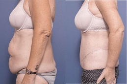 Body Lift – Belt Lipectomy Clinic in dubai & Abu Dhabi
