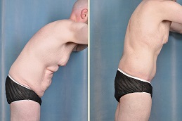 Body Lift – Belt Lipectomy in dubai