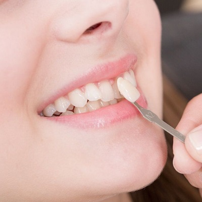 Can Veneers Fix Protruding Teeth Dubai?