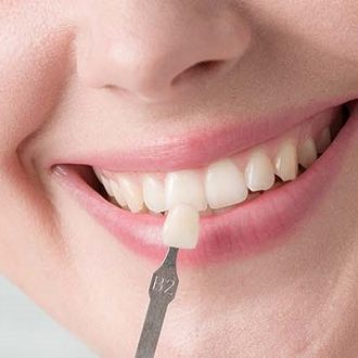 Composite Veneers Dubai & Abu Dhabi Price