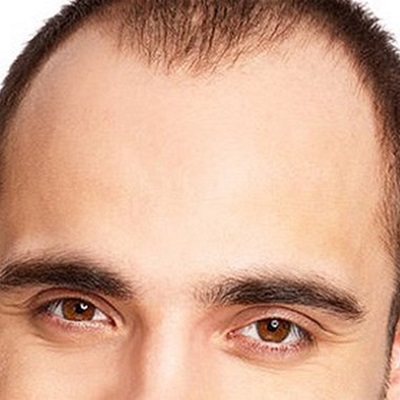 Eyebrow Transplant for Alopecia Areata Dubai