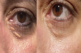 Eyelid Xanthelasma Removal Clinic in dubai & Abu Dhabi