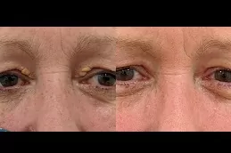 Eyelid Xanthelasma Removal in dubai