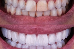 Hollywood Smile Dubai