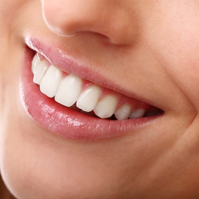 Hollywood Smile in Dubai, Abu Dhabi & Sharjah Royal Clinic