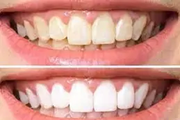 Hollywood Smile in Dubai