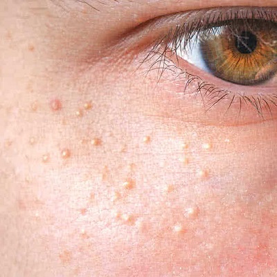 Milia Treatment in Dubai, Abu Dhabi & Sharjah Royal Clinic