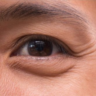 Non-Surgical Eye Bag Removal Dubai & Abu Dhabi