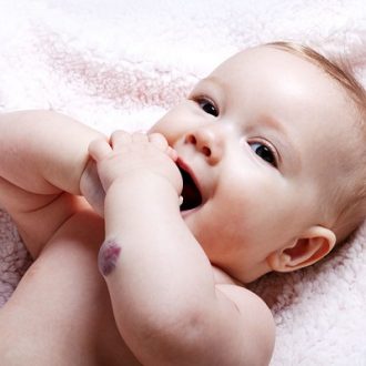 Strawberry Hemangioma Treatment for Baby in Dubai