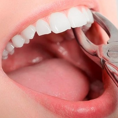 Surgical Tooth Removal in Dubai, Abu Dhabi & Sharjah Royal Clinic