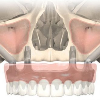 Zygomatic Implants Cost in Dubai & Abu Dhabi