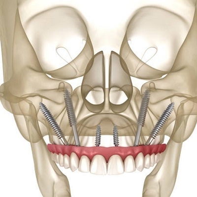 Zygomatic Implants in Dubai, Abu Dhabi & Sharjah Royal Clinic