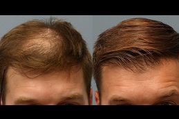 baldness-treatment-cost Clinic in Dubai
