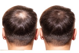 baldness-treatment-cost in Abu Dhabi