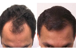baldness-treatment-cost in dubai