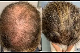 best baldness-treatment-cost in dubai