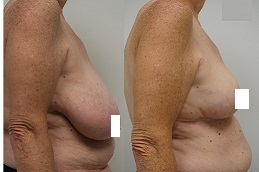 best breast-reduction-surgery-cost-2022-with-insurance in dubai