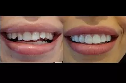 best composite-veneers-dubai-price