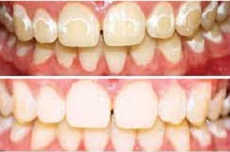 best dental-activators-cost in dubai