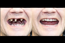 best dentures-cost in dubai