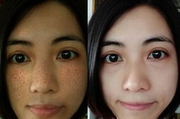 best do-glutathione-injections-help-with-weight-loss in dubai