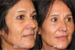 best face-fat-transfer in dubai