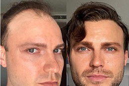 best hair-transplant-prices in dubai