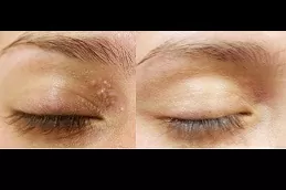 best milia-treatment in dubai