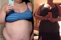 best mini-gastric-bypass-cost in dubai