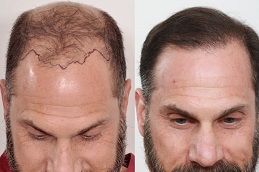 best natural-hairline-treatment-cost in dubai