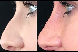 best non-surgical nose lift in dubai