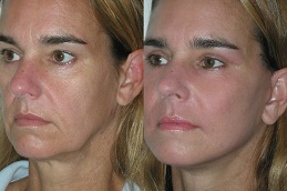 best pdo-threads-for-jawlines in dubai