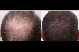 best plasma-hair-treatment in dubai