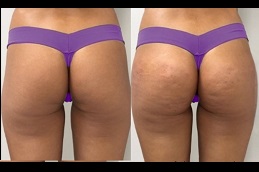 best sculptra-injections-buttocks-price-dubai