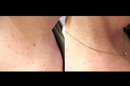 best skin-lesion-removal-cost in dubai