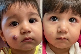 best strawberry-hemangioma-treatment-for-baby in dubai