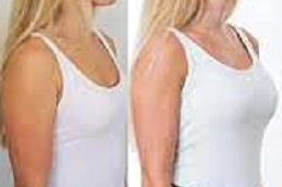breast-implants-cost in dubai
