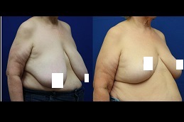 breast-reduction-surgery-cost-2022-with-insurance in Abu Dhabi
