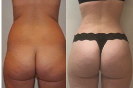 butt-fillers Clinic in Dubai