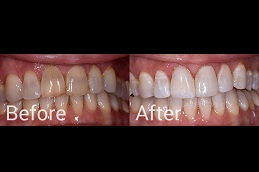 composite-veneers-Abu Dhabi-price