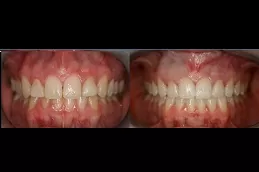 composite-veneers-Clinic-dubai-price