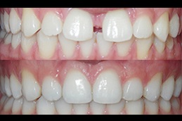 dental-activators-cost Clinic in Dubai